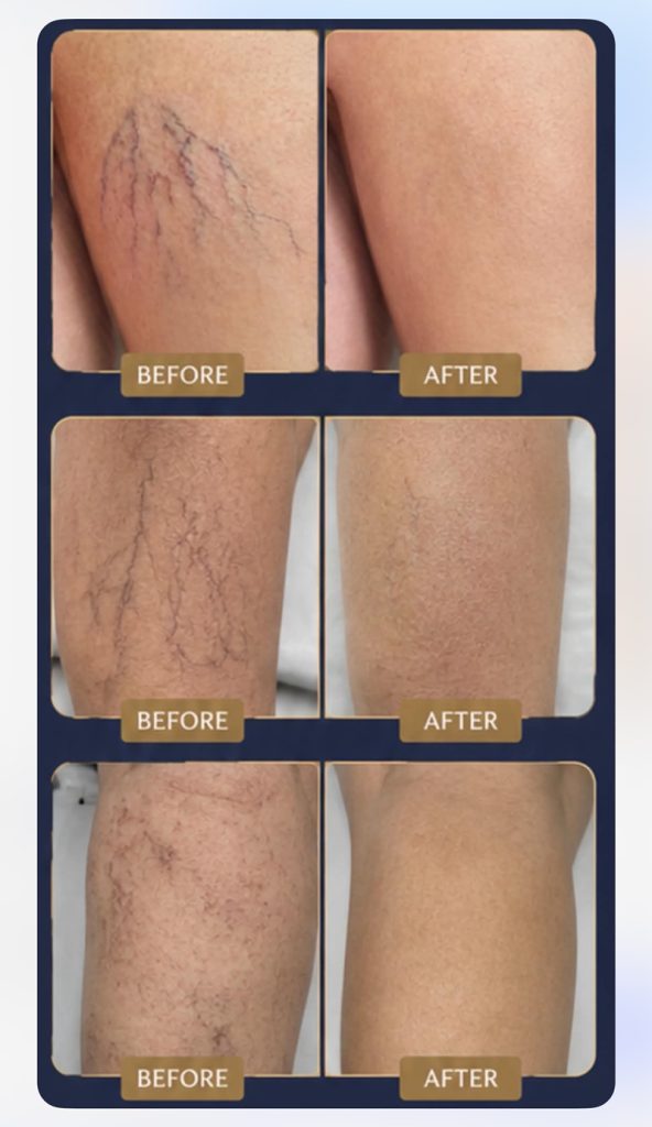 microsclerotherapy